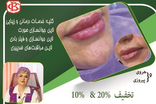   تزریق بوتاکس  ۱۵۰۰ با تخفیف ۱۳۵۰ 